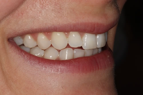 after treatment
