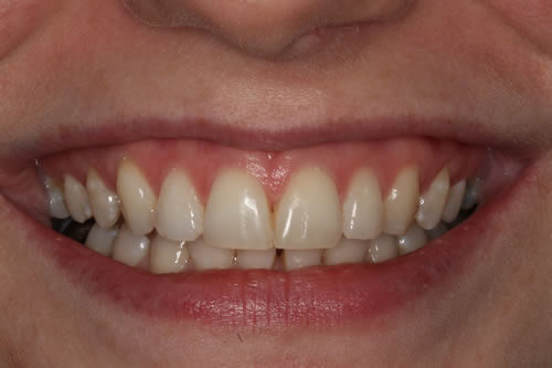 after treatment