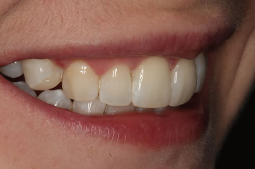 after treatment