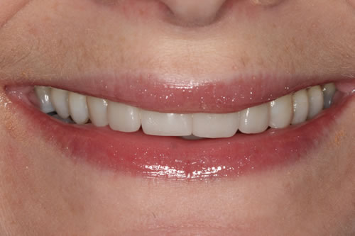 after treatment