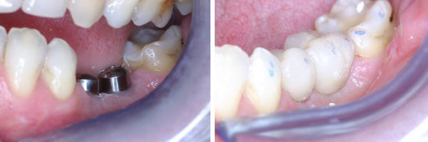 Dental Implant before and after treatment photo