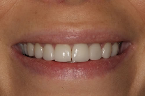 after treatment