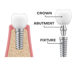 Dental Implant