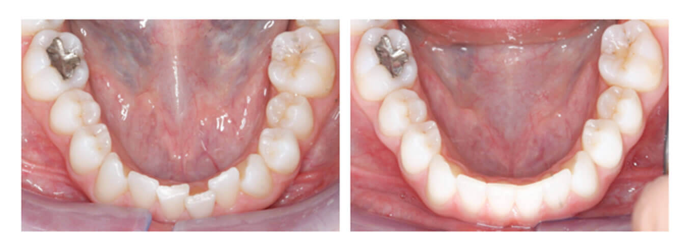 Children's Braces