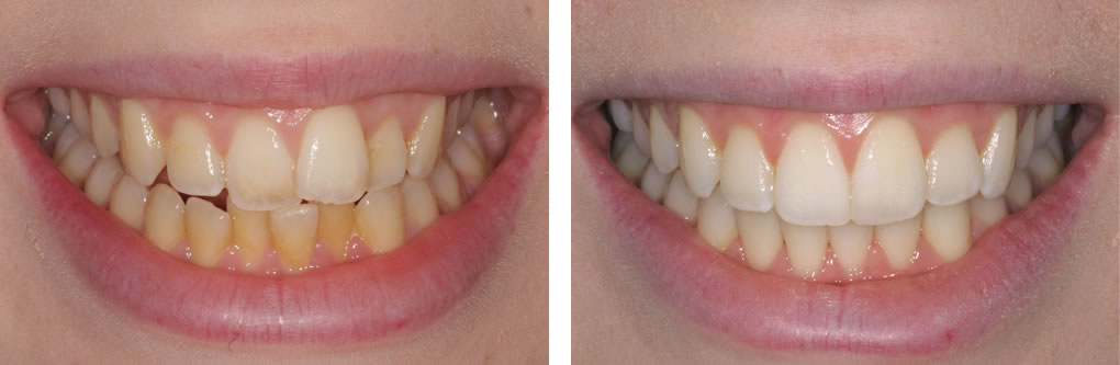 Clear Aligner Before and after treatment photos