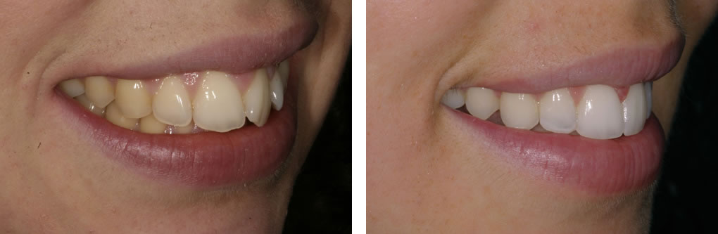 Clear Aligner before and after treatment photos
