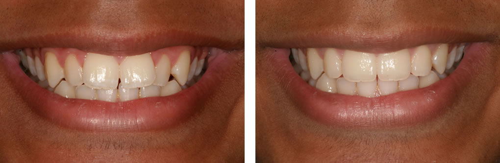 Clear Aligner before and after treatment photos