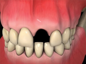 Dental Implants Navan