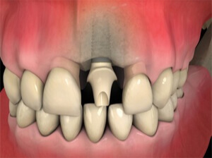 dental implant is placed into the jaw bone