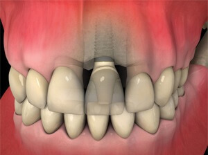 dental crown is then made to attach to the dental implant post