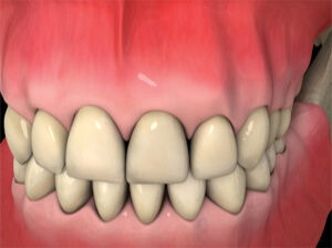 The dental crown is screwed or cemented onto the dental implant post