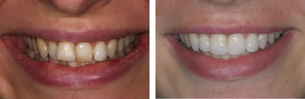 Inman Aligner Before & After photo
