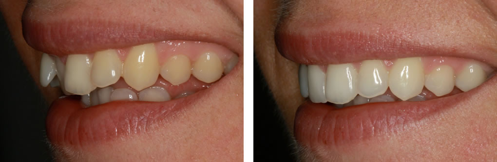 Inman Aligner Before and After Photo