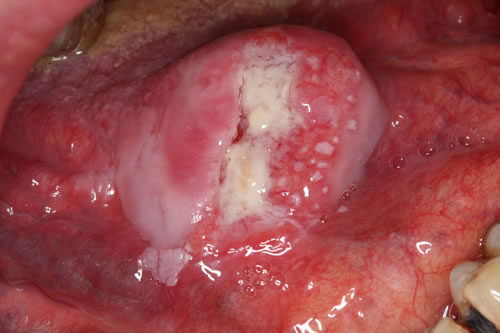 Mouth Cancer Awareness at Navan Dental
