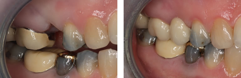 Dental Bridge before and after treatment available from Navan Dental