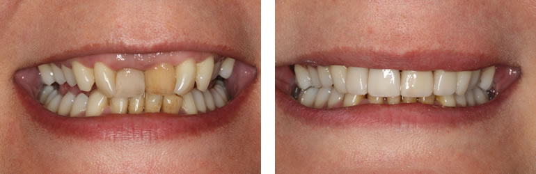 Dental Crowns available from Navan Dental
