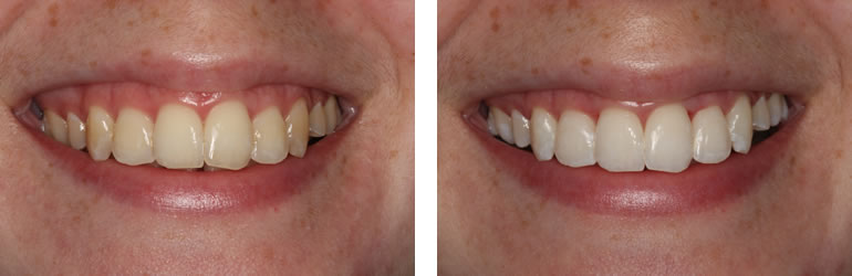 Before and after photo of Teeth Whitening treatment available from Navan Dental