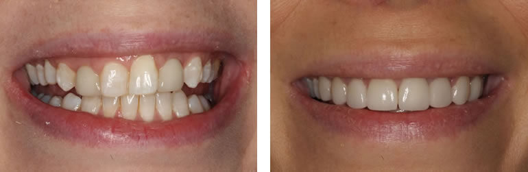 Before and after veneers treat at Navan Dental