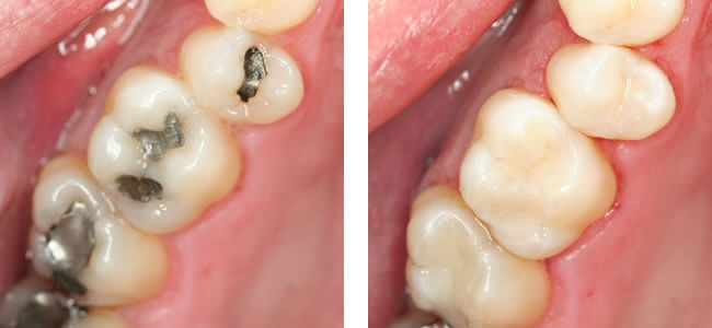 White Fillings available at Navan Dental