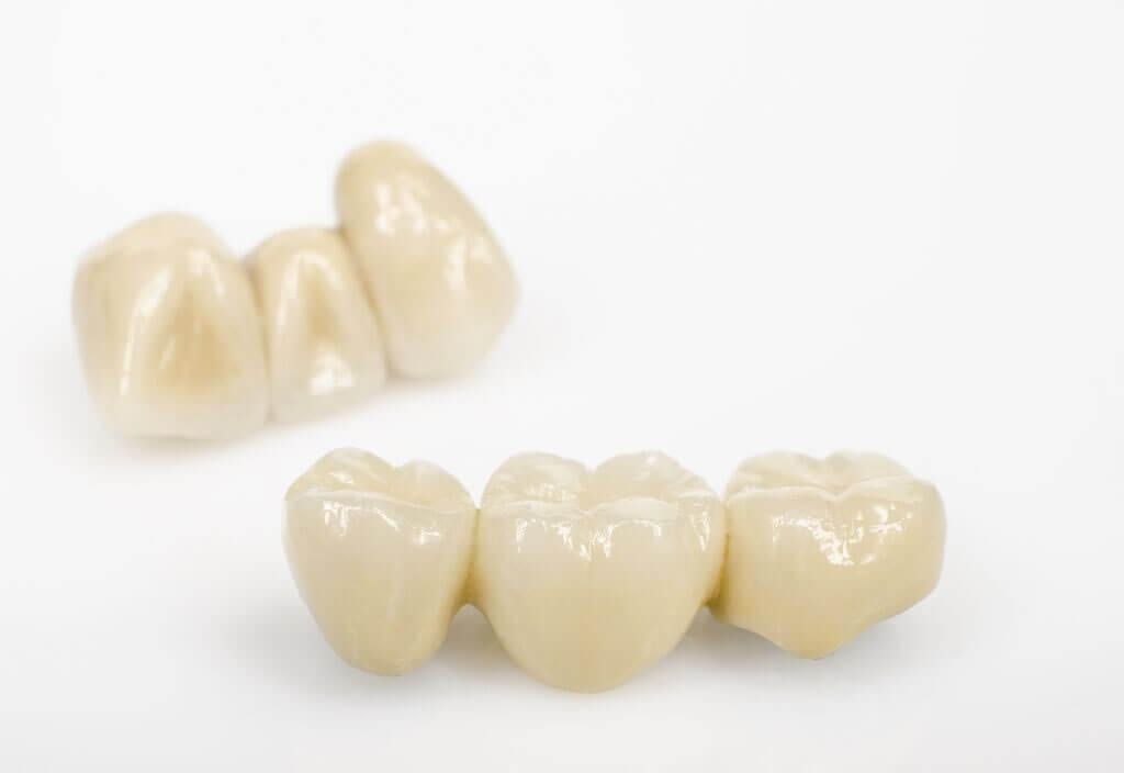 An example of a dental bridge available at Naval Dental