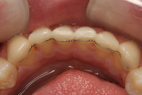 Fixed Retainers Available at Navan Dental