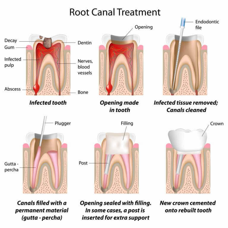 Root Canal Treatments available at Navan Dental
