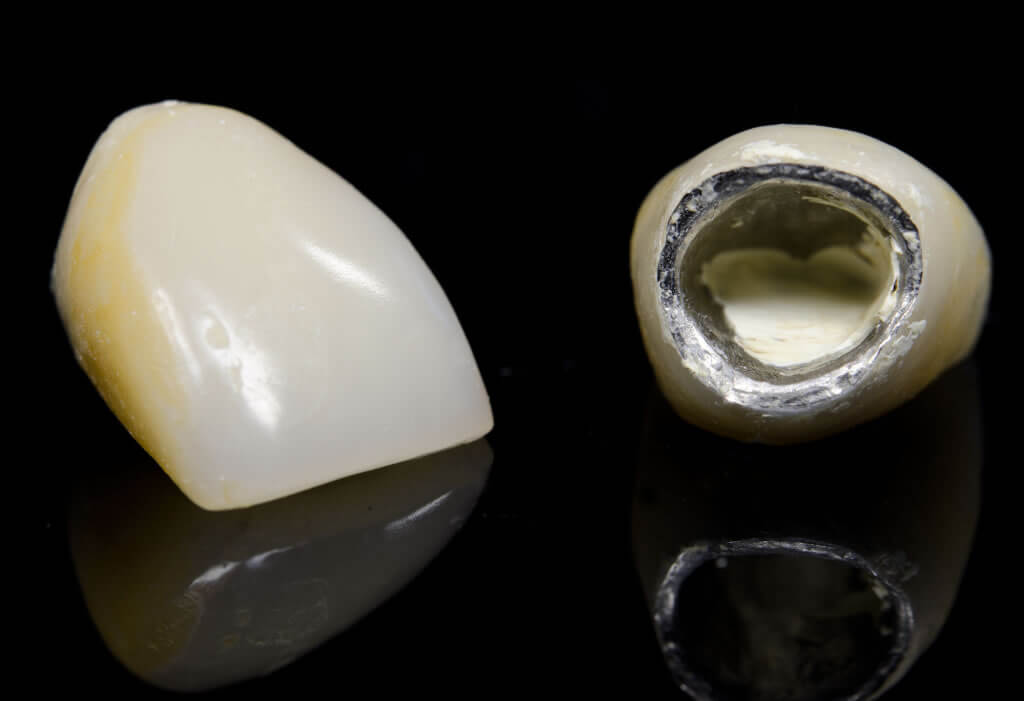 Metal Ceramic Crowns available at Navan Dental