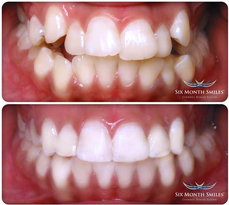 Six Month Smiles before and after photo