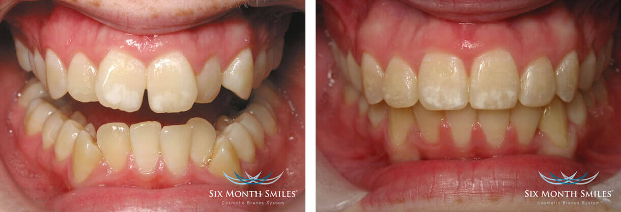 Six Month Smiles before and after photo