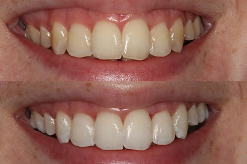 Teeth Whitening Offer