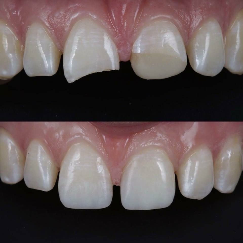 Tooth Contouring by dentists in Navan
