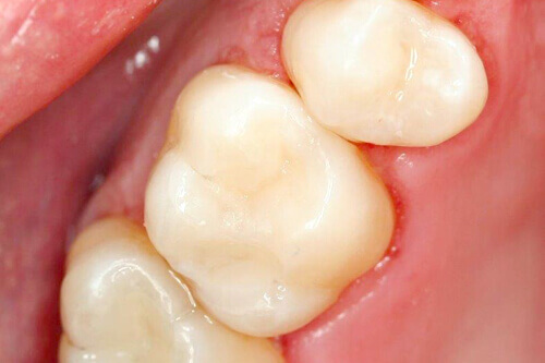 White Fillings